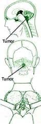 Craneotomía Osteoclástica Suboccipital para Extirpar un Tumor de la Fosa posterior
