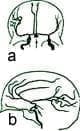 Aneurismas Cerebrales
