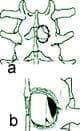 Hemilaminectomía para hernia lateral del disco