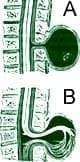 A) Meningocele B) Meningomieloradiculocele A) Meningocele B) Meningomieloradiculocele