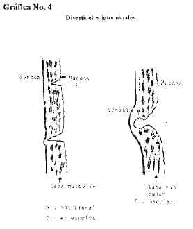 Divertículos intramuscular