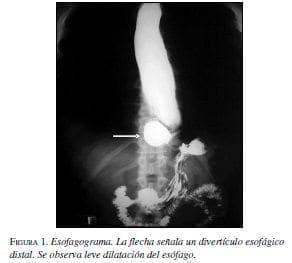 Esofagograma. La flecha señala un divertículo esofágico distal Esofagograma. La flecha señala un divertículo esofágico distal