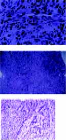 Diagnóstico de Rabdomiosarcoma