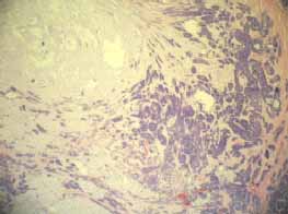 Tumor lobulo