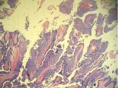Papilas de siringocistoadenoma