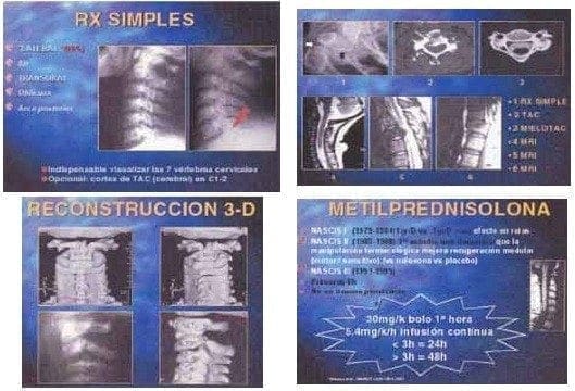 Diagnóstico trauma espinal