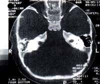 Tomografía Axial Computarizada de hueso temporal a nivel Antro Mastoideo