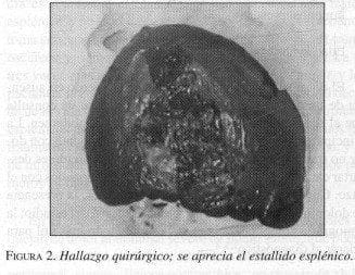 Hallazgo Quirúrgico; se aprecia el estallido Esplénico