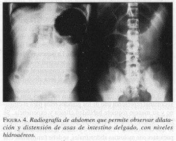 Asas de intestino delgado, con niveles Hidroaéreos