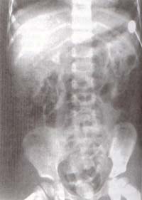 Placa de evacuación post-urografía