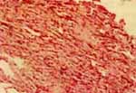 Biopsia Transbronquial Biopsia Transbronquial