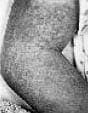 Linfadenitis de Kikuchi