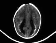 Hidrocefalia