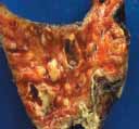 Lesiones abscedificadas del pulmón