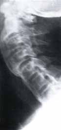 Radiografía de Columna Cervical, proyección lateral: