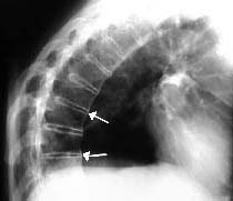 Paciente con Espondilitis anquilosante