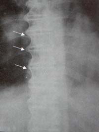 Columna Dorso-lumbar.