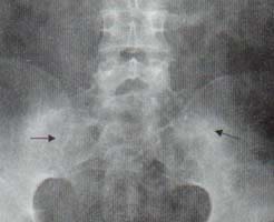 Radiografía de pelvis