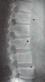 Radiografía de columna lumbar