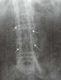 Radiografía de columna lumbar
