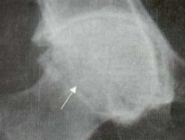 Cadera. Disminución del espacio articular, migración axial de la cabeza femoral