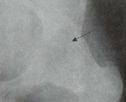 Cadera. Anquilosis completa con formación de puentes óseos entre la cabeza y el iliaco (Flecha)