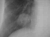 Adenocarcinoma basal derecho. Adenocarcinoma basal derecho.