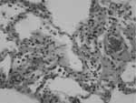 Capilaritis. H-E 40x.