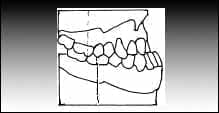 Maloclusiones Dentales, Clase 3 de Angle.
