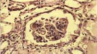 Microfotografía de otro glomérulo mostrando engrosamiento