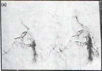 Arteriografía bronquial