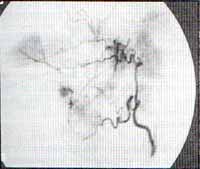 arteriografía bronquial derecha