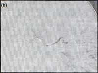 Control de embolización con partículas de gelfoam + alcohol absoluto