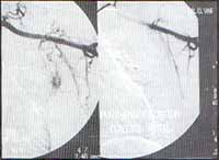 Hemoptisis por aspergiloma
