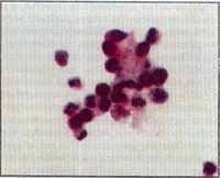 eosinófilos en la fase aguda eosinófilos en la fase aguda