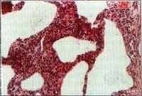 Biopsia pulmonar.con Engrosasmiento septal Biopsia pulmonar.con Engrosasmiento septal