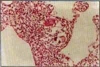 Bopsia pulmonar con Presencia de granuloma Bopsia pulmonar con Presencia de granuloma
