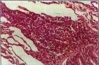 Bopsia pulmonar con Presencia de Pseudogranuloma Bopsia pulmonar con Presencia de Pseudogranuloma