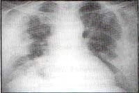 Bronconeumonia