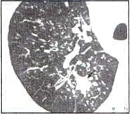 TAC de tuberculosis