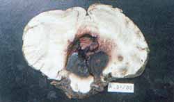Fotomicrografía de la malformación vascular intraparenquimatosa del cerebelo