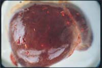 Lesiones granulomatosas miliares hepáticas