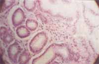 Biopsia de estómago,edema de lámina propia