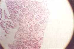 Biopsia de cuerpo gástrico, incremento de glándulas y edema de lámina propia