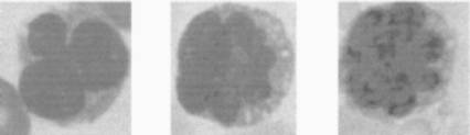 Aspecto de los linfocitos infectados por el virus HTLV-1