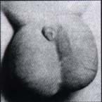 Edema escrotal 