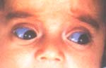 Paciente conosteogénesis imperfecta y esclera azul Paciente conosteogénesis imperfecta y esclera azul