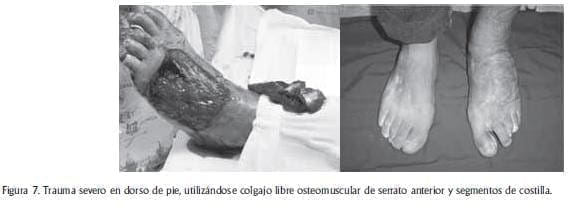Trauma severo en dorso de pie Trauma severo en dorso de pie