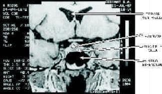 Microadenoma hipofisiario en resonancia nuclear