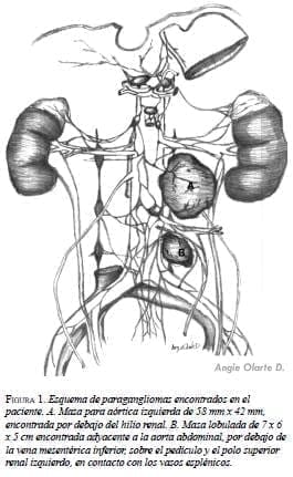 Esquema del paraganglioma del órgano de Zuckerkandl